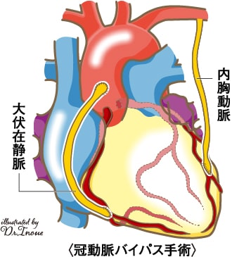 心臓解剖図 虚血性心疾患