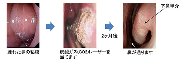 アレルギー鼻炎レーザー治療